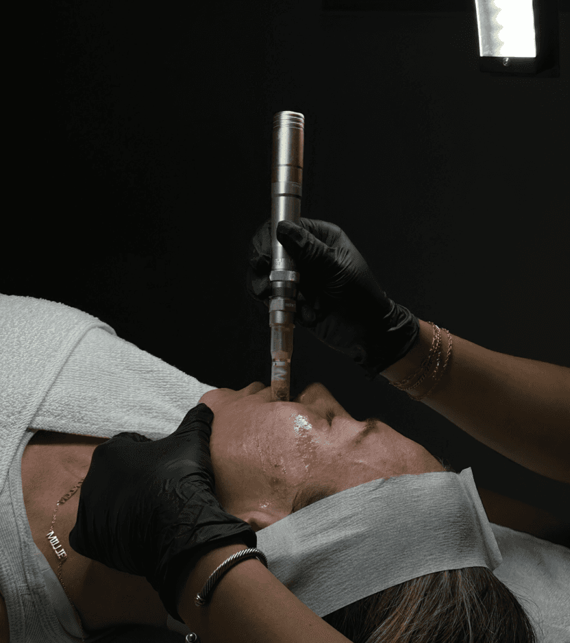 Microneedling