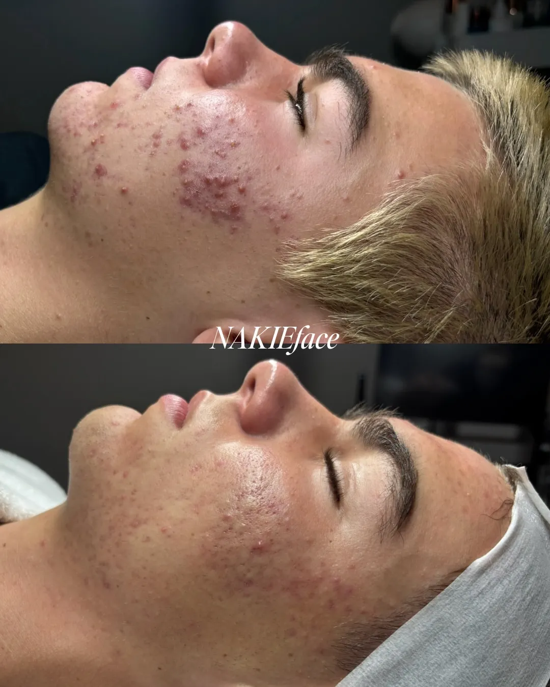 Face Reality acne transformation